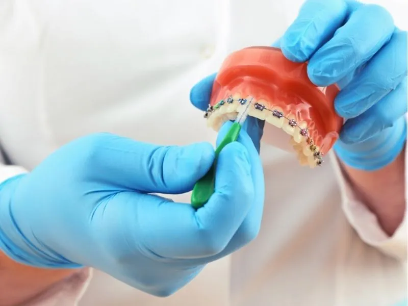 Niềng răng có đi máy bay được không